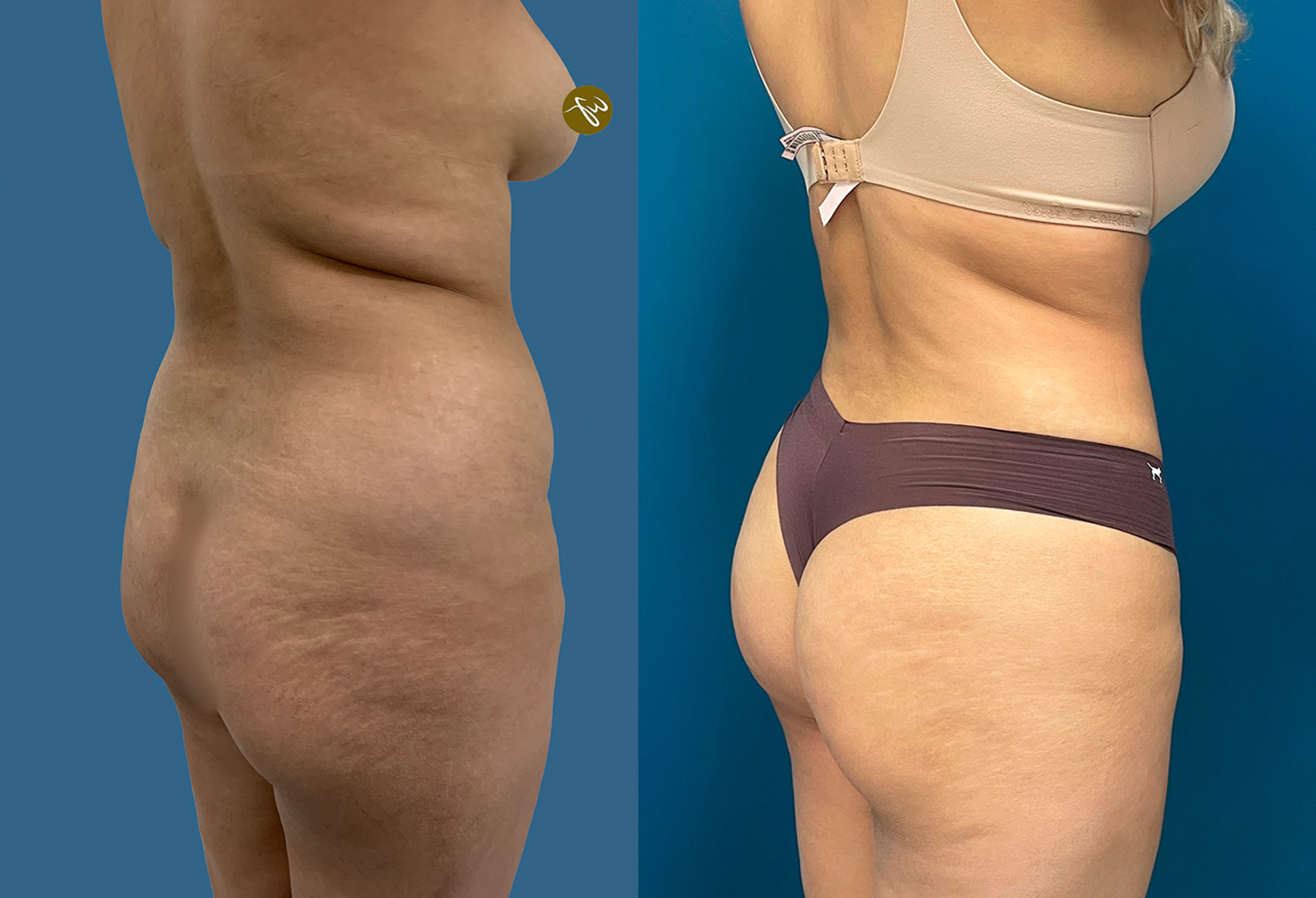 lipotransferencia mujeres