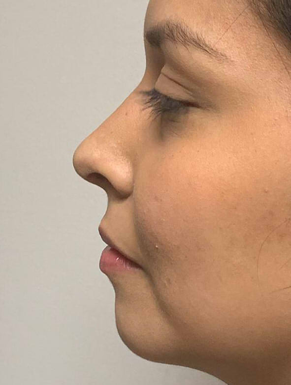 Rinoplastia2.jpg