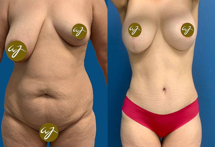 Antes-y-despues-arreglado-11